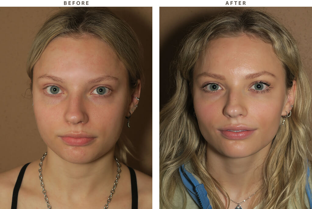 ورم بوکال فت چند روز طول می کشد؟ 2 ورم بوکال فت چند روز طول می کشد