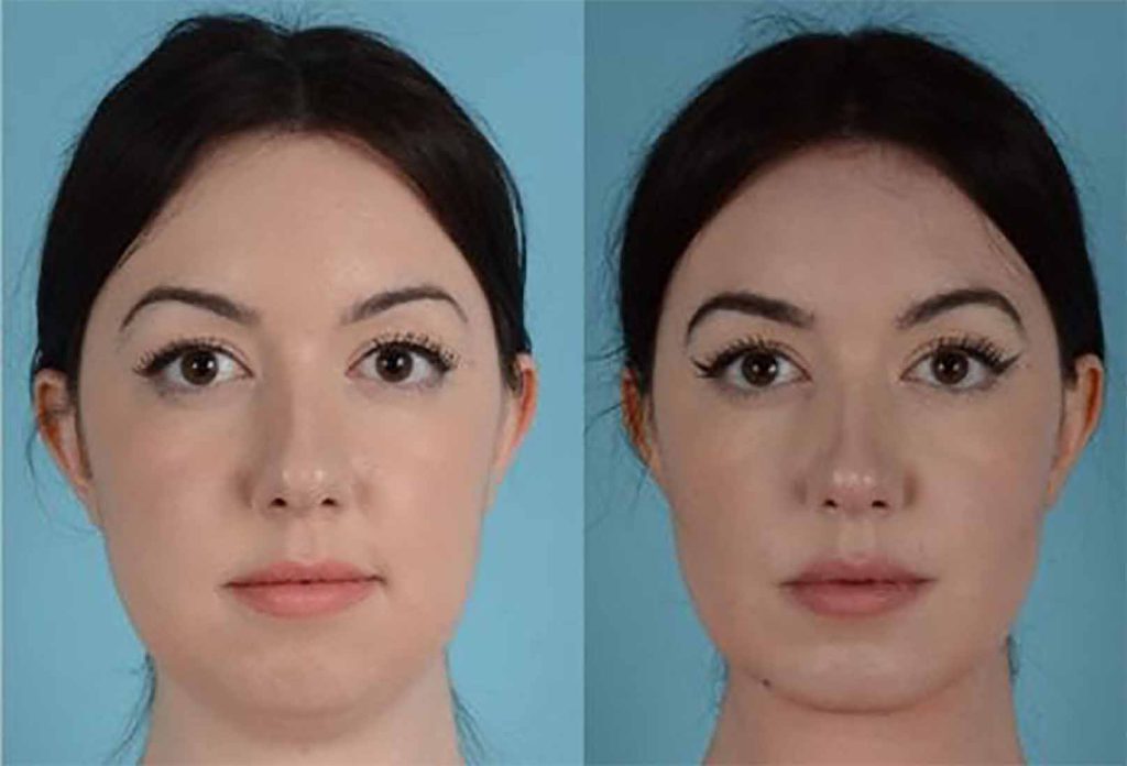 بوکال فت غبغب چیست و چگونه انجام می شود؟ 1 بوکال فت غبغب چیست