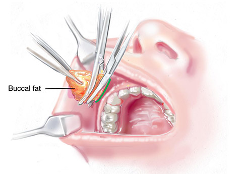 بوکال فت چیست؟ (مزایا، عوارض و روش انجام)عمل بوکال فت چیست؟ 1 جراحی بوکال فت جیست