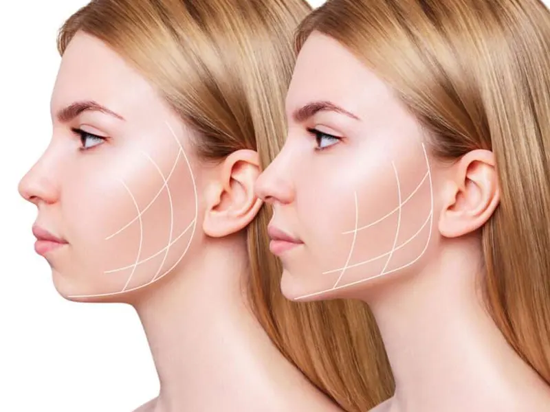 بوکال فت چیست؟ (مزایا، عوارض و روش انجام)عمل بوکال فت چیست؟ 2 عمل بوکال فت چیست