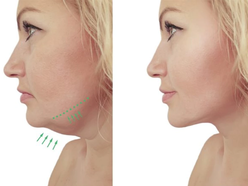 بوکال فت غبغب چیست و چگونه انجام می شود؟ 2 چه کسانی نباید بوکال فت غبغب را انجام دهند؟