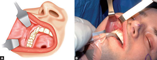 تخلیه بوکال فت چطور انجام میشود؟ عوارض آن چیست 3 نحوه تخلیه بوکال فت