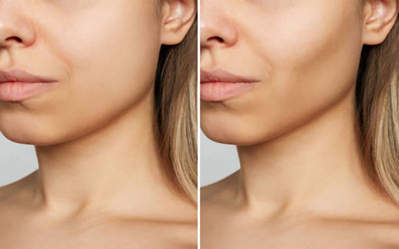 تخلیه بوکال فت چطور انجام میشود؟ عوارض آن چیست 2 تخلیه بوکال فت به چه صورت انحام میشود