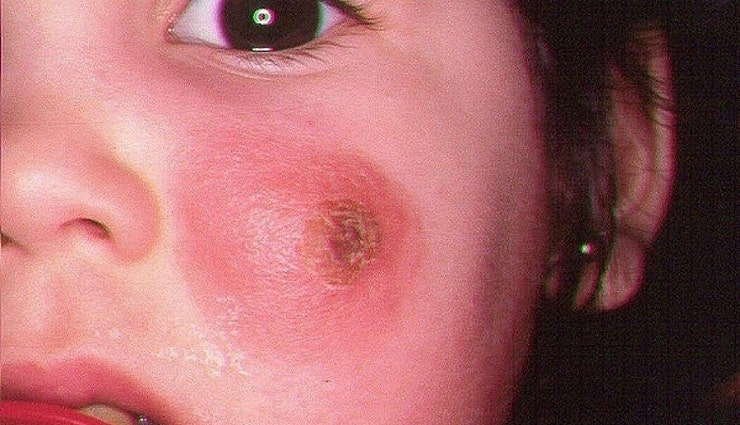 بیماری سالک چیست - درمان قطعی سالک 2 درمان قطعی سالک