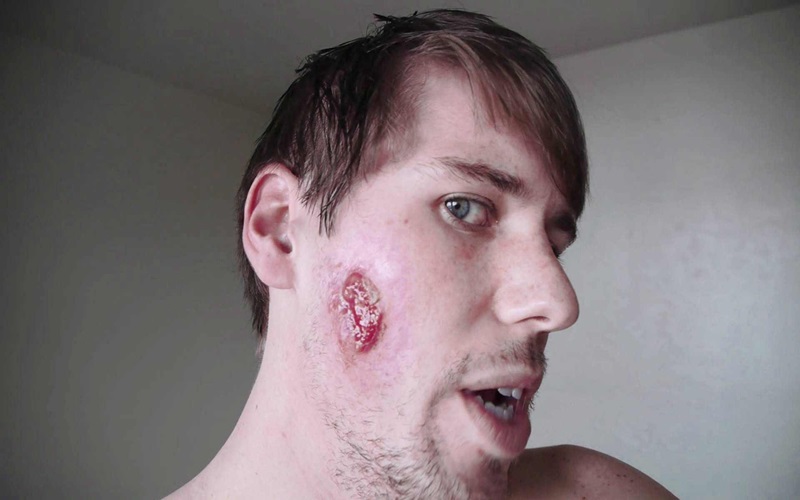 از کجا بفهمیم سالک داریم؟ (معرفی علائم سالک پوستی) 1 تتت