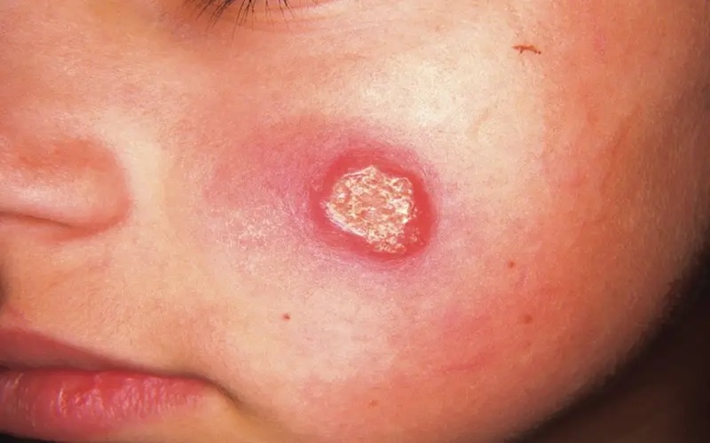 از کجا بفهمیم سالک داریم؟ (معرفی علائم سالک پوستی) 2 تتتتت