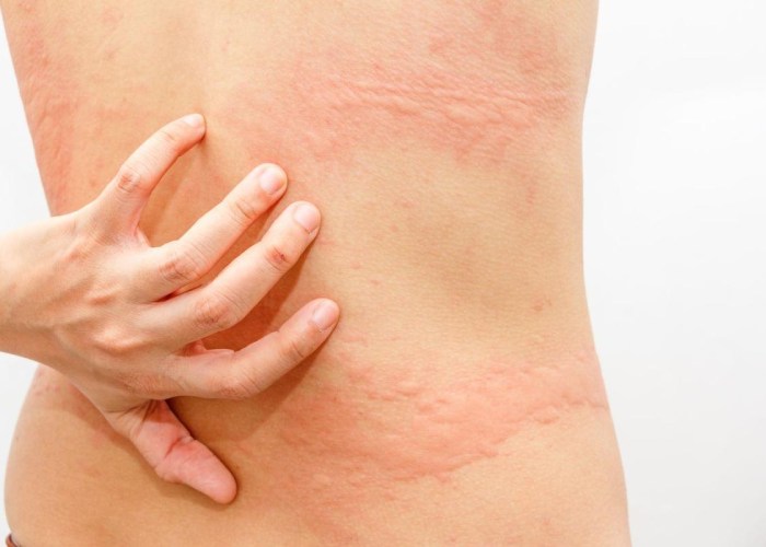 علل خارش پوست چیست؟ 3 علل خارش پوست چیست؟