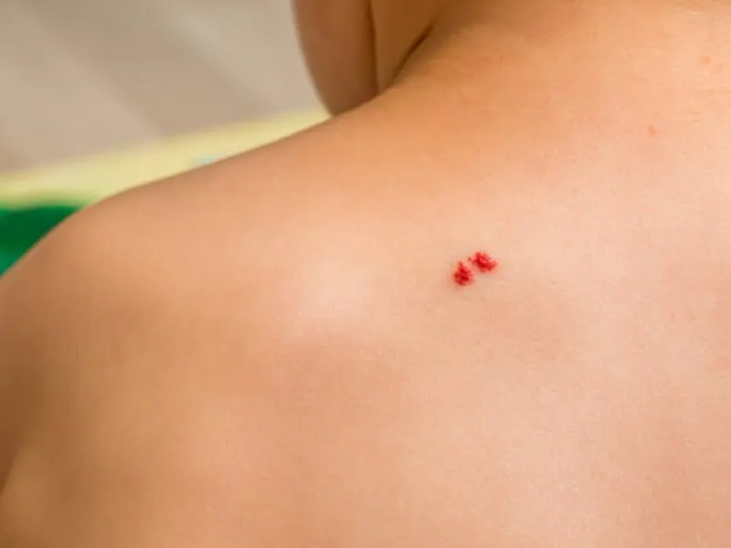 علت خال گیلاسی چیست؟ 1 علت خال گیلاسی