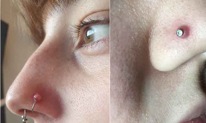 کلوئید ناشی از پیرسینگ و درمان قطعی آن 3 کلوئید ناشی از پیرسینگ