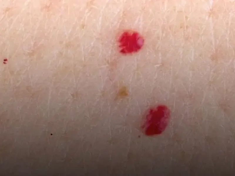 راهکارهای درمان خال گیلاسی 2 درمان خال گیلاسی