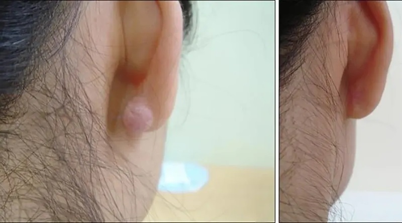 کلوئید ناشی از پیرسینگ و درمان قطعی آن 2 کلوئید ناشی از پیرسینگ