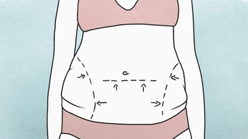 تزریق چربی به هیپ دیپ : یک رویکرد نوین 2 تزریق چربی به هیپ دیپ