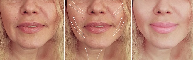 تزریق چربی به گونه: روشی برای زیبایی گونهها 2 تزریق چربی به گونه