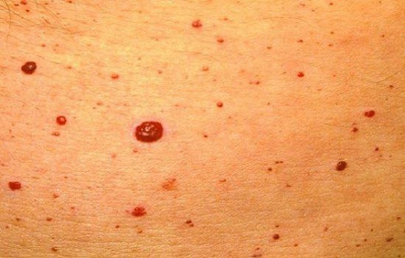 خونریزی خال گیلاسی : علل، علائم، و روشهای مدیریت 2 خونریزی خال گیلاسی