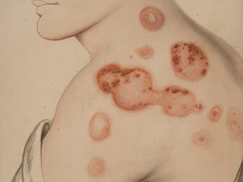 بررسی روشهای موثر در درمان پمفیگوس 2 درمان پمفیگوس