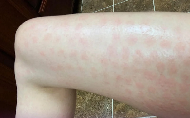 سوختگی با لیزر را چگونه درمان کنیم؟ راهنمای جامع درمان و پیشگیری 1 سوختگی ناشی از لیزر چیست