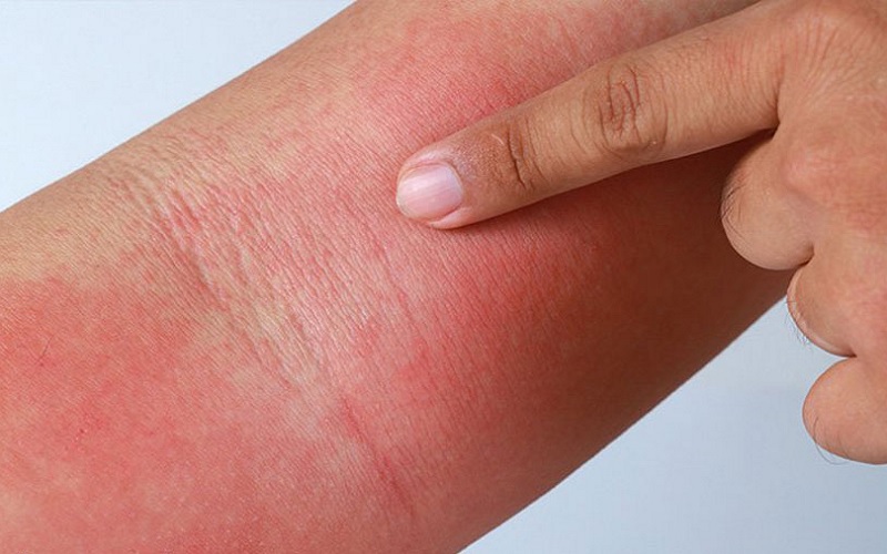 سوختگی با لیزر را چگونه درمان کنیم؟ راهنمای جامع درمان و پیشگیری 2 علائم سوختگی با لیزر