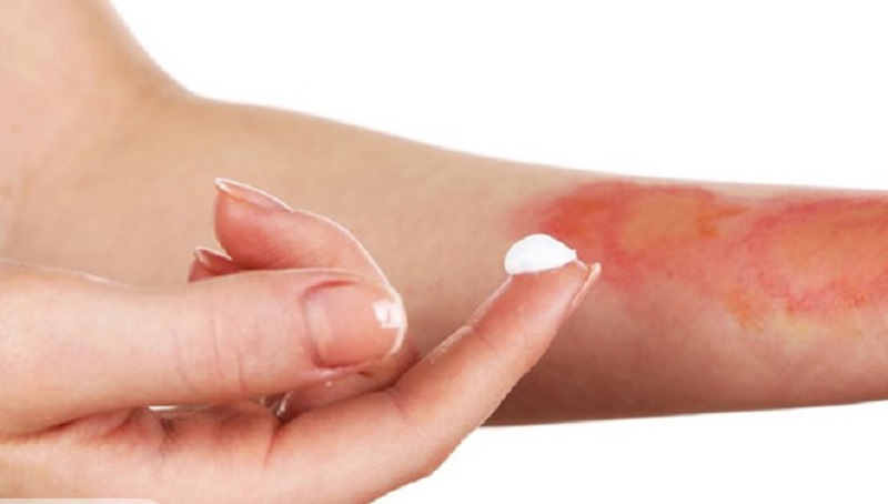 سوختگی با لیزر را چگونه درمان کنیم؟ راهنمای جامع درمان و پیشگیری 3 12