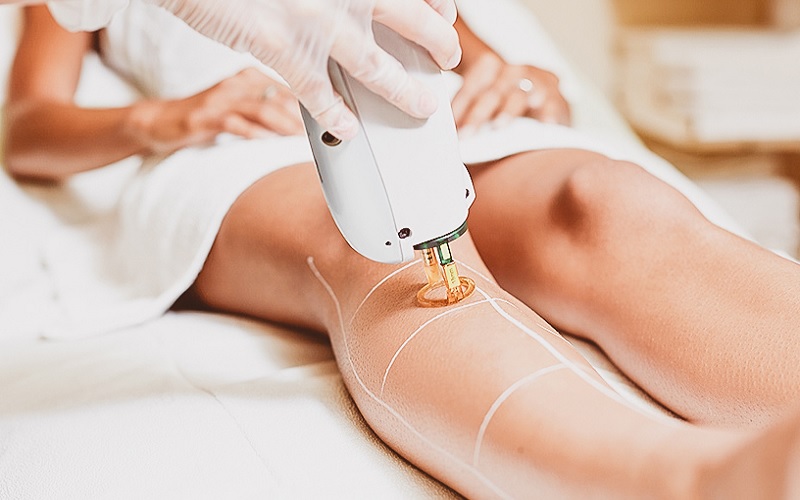 تعداد جلسات لیزر موهای زائد چقدر است؟ 1 لیزر موهای زائد چگونه کار میکند؟