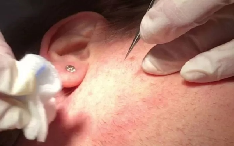 تفاوت الکترولیز و لیزر در رفع موهای زائد 3 کدام روش برای شما مناسبتر است