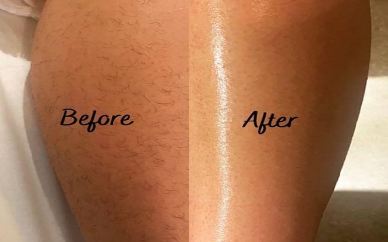 اپیلاسیون یا لیزر، کدام بهتر است؟ 3 مزایا و معایب لیزر