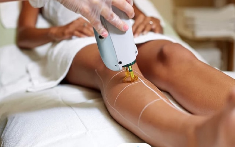 7 تا از روش های حذف موهای زائد: مزایا، معایب و انتخاب مناسب برای شما 1 لیزر موهای زائد