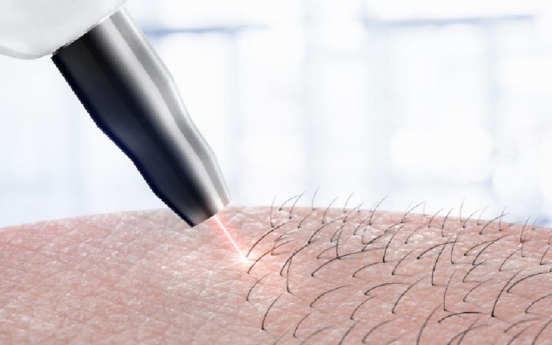 لیزر موهای زائد یا کرم موبر؟ کدام روش بهتر است؟ 3 معایب لیزر موهای زائد