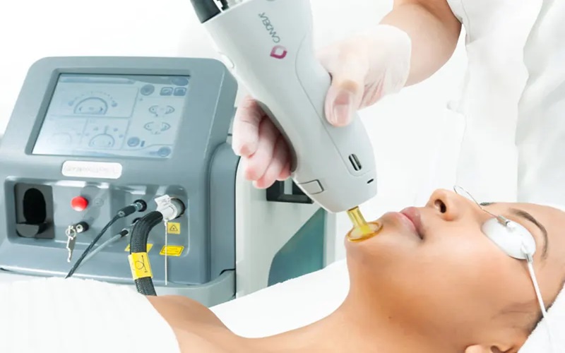 دستگاه لیزر کندلا بهتر است یا الکس؟ مقایسه دو فناوری لیزر برای درمان موهای زائد 1 دستگاه لیزر کندلا