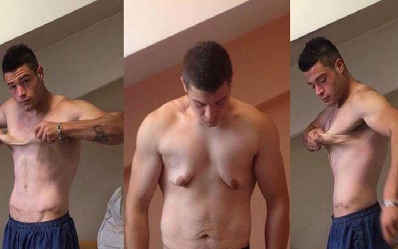 روشهای جلوگیری از افتادگی پوست بعد از لاغری: راهنمای جامع 1 روشهای جلوگیری از افتادگی پوست بعد از لاغری: راهنمای جامع