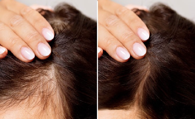 درمان خانگی ریزش مو بعد از کراتینه: راهکارهای موثر برای بازگرداندن سلامت موها 3 جلوگیری از ریزش مو بعد از کراتینه