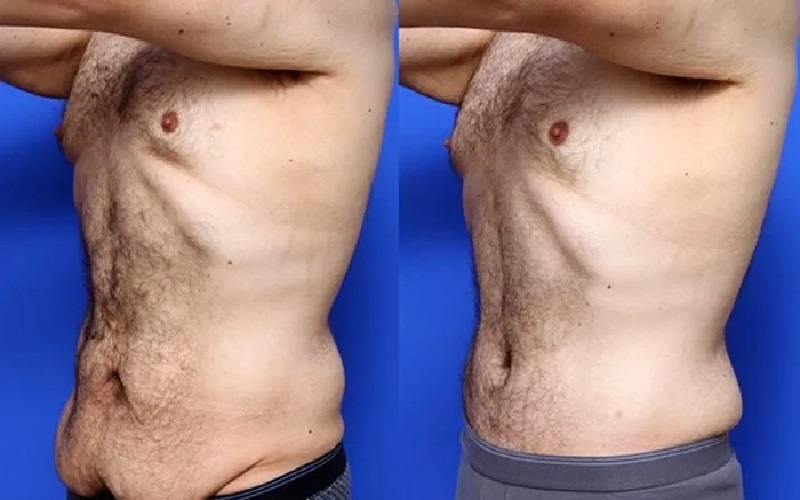 روشهای جلوگیری از افتادگی پوست بعد از لاغری: راهنمای جامع 3 چرا پوست بعد از لاغری شل میشود