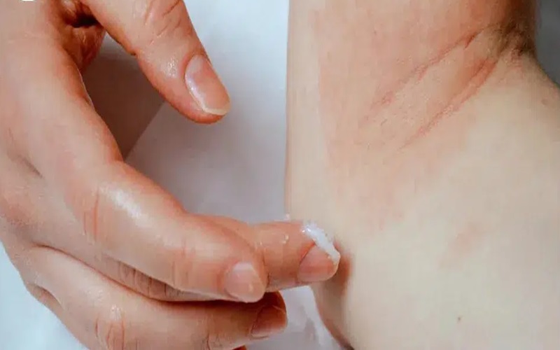 خارش بعد از لیزر کندلا: علل، درمانها و نکات پیشگیرانه 3 نکات پیشگیرانه برای جلوگیری از خارش پس از لیزر کندلا