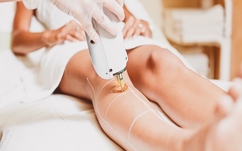 تعداد جلسات لیزر کندلا: راهنمای جامع برای درمان موهای زائد با لیزر 1 تعداد جلسات لیزر کندلا