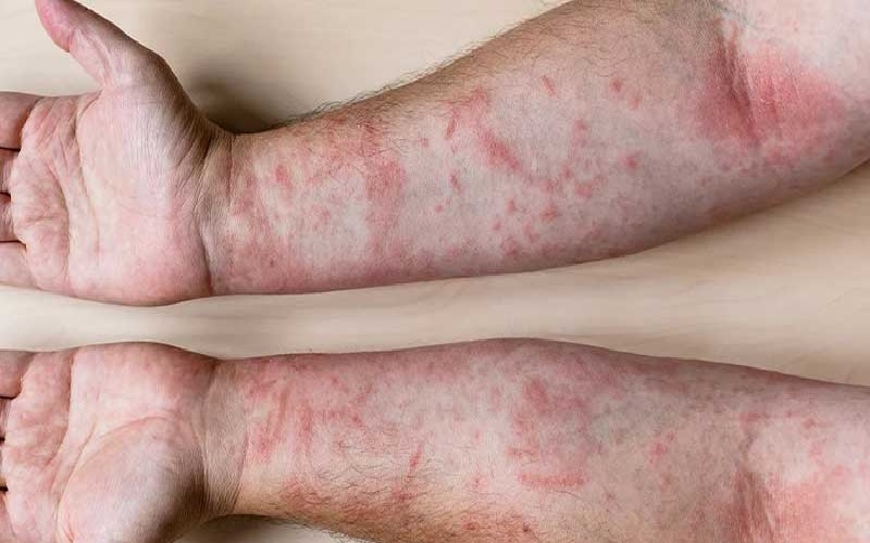 لیزر برای چه کسانی ممنوع است؟ 1 افراد دارای بیماری های پوستی و حساسیتهای شدید