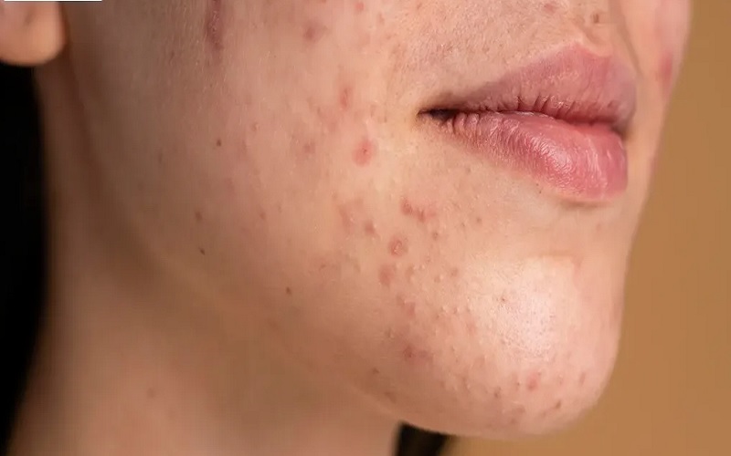 لیزر برای چه کسانی ممنوع است؟ 2 افرادی که داروهای خاص مصرف میکنند