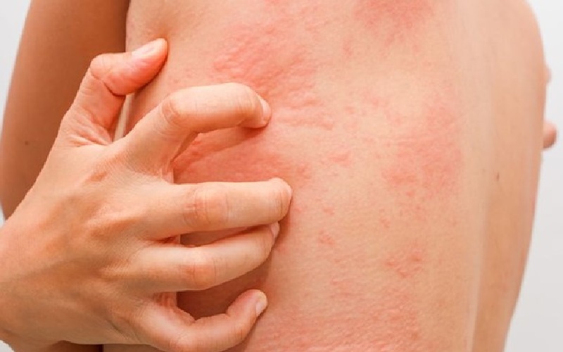 خارش بعد از لیزر کندلا: علل، درمانها و نکات پیشگیرانه 1 خارش بعد از لیزر کندلا