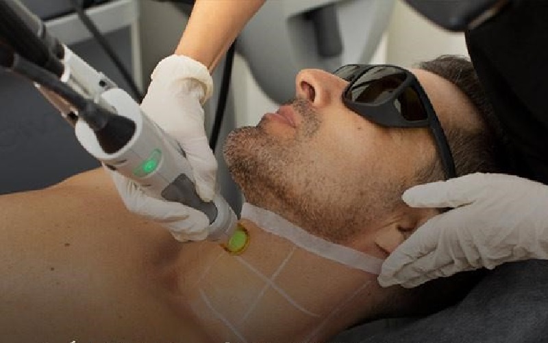 انجام لیزر خط ریش برای آنکارد کردن صورت آقایان 1 لیزر خط ریش