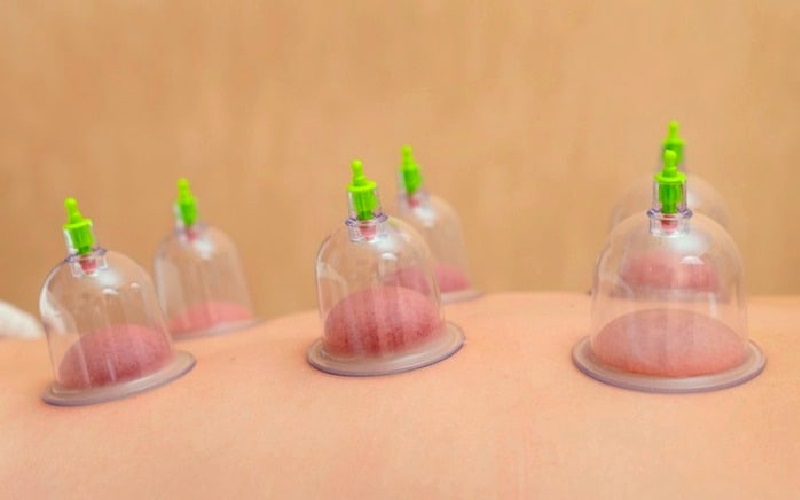 آیا بادکش برای لاغری شکم موثر است؟ بررسی علمی و تجربی 1 بادکش برای لاغری