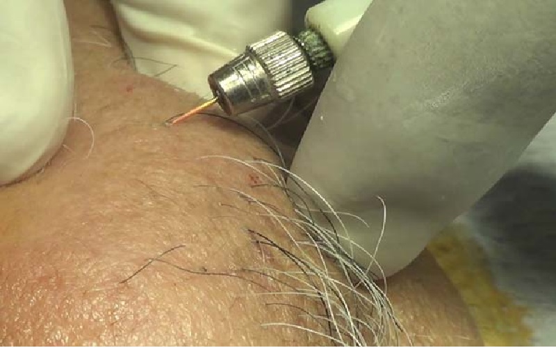 از بین بردن موهای سفید با لیزر: روشها، مزایا و نکات مهم 1 از بین بردن موهای سفید با لیزر: روشها، مزایا و نکات مهم