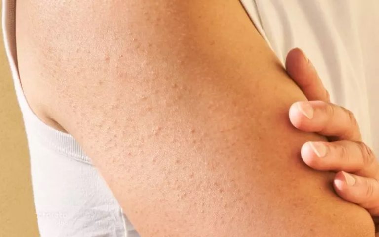 درمان پوست مرغی