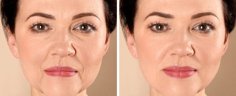 پروفایلو یا فیلر