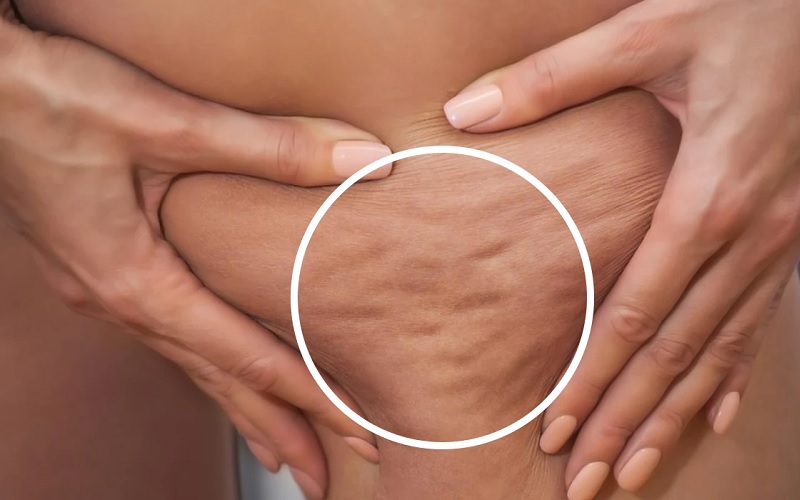 درمان سلولیت در اصفهان 1 رفع سلولیت