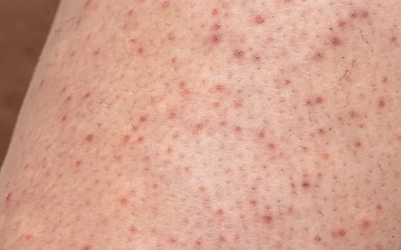 درمان پوست مرغی 1 34