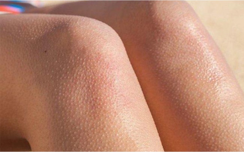 درمان پوست مرغی 2 35