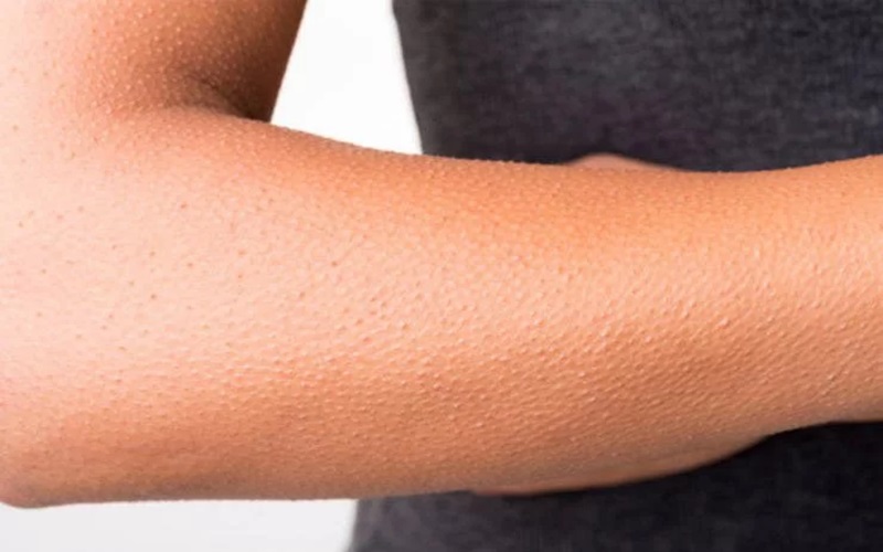 درمان پوست مرغی 3 پوست مرغی در کدام نواحی بدن ایجاد میشود؟