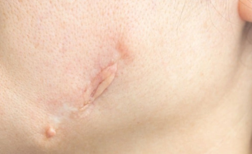 علت ایجاد اسکار کلوئیدعلت ایجاد اسکار کلوئیدعلت ایجاد اسکار کلوئید 2 نحوه شکل گیری کلوئید