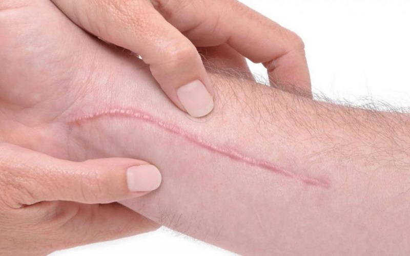 علت ایجاد اسکار کلوئیدعلت ایجاد اسکار کلوئیدعلت ایجاد اسکار کلوئید 3 39