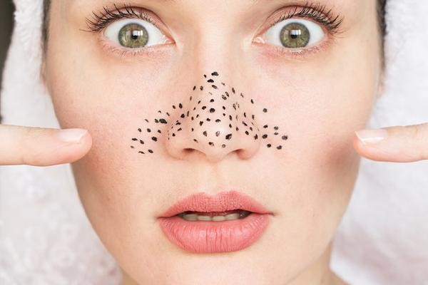 درمان جوش سر سیاه