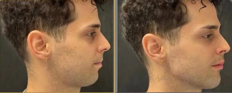 زاویه سازی فک آقایان