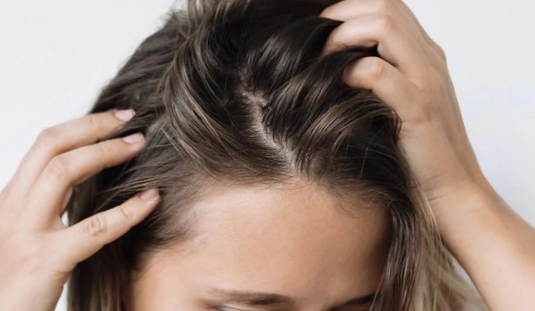 درمان چربی کف سر